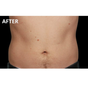 CoolSculpting® After Result Toronto & Mississauga