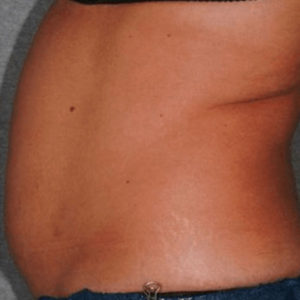 CoolSculpting® Before Result Toronto & Mississauga