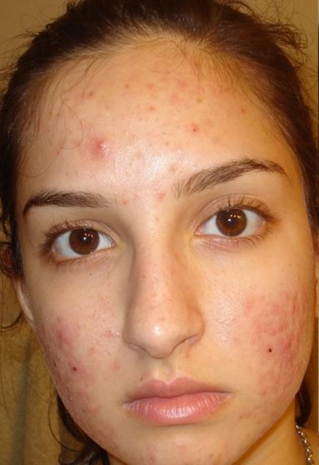 acne-4743-before