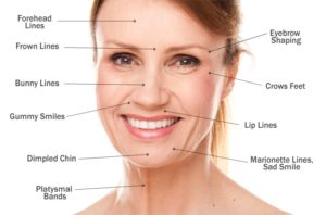 Botox Face and Neck Diagram Toronto & Mississauga