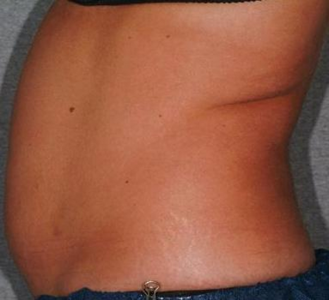 Coolsculpting Before Result Toronto & Mississauga
