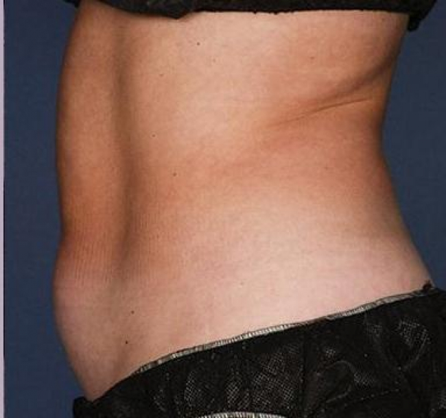Coolsculpting After Result Toronto & Mississauga