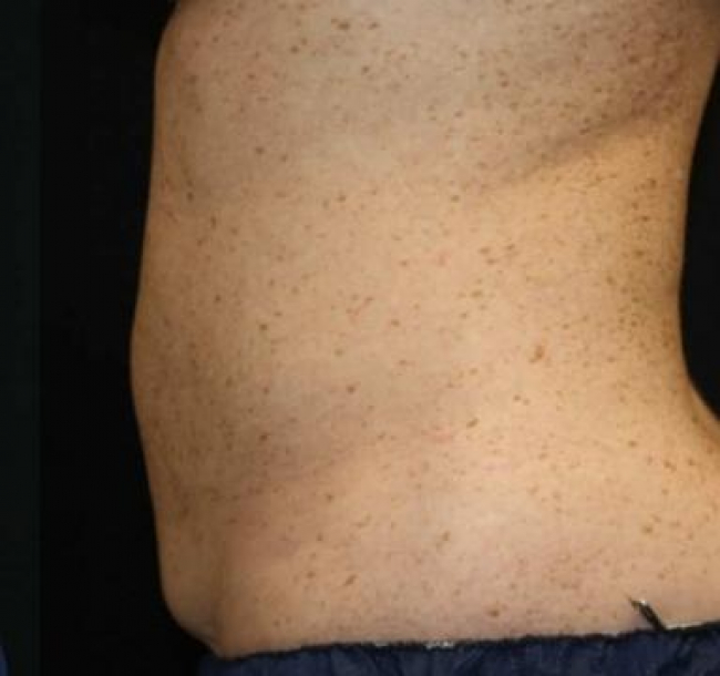 Coolsculpting After Result Toronto & Mississauga