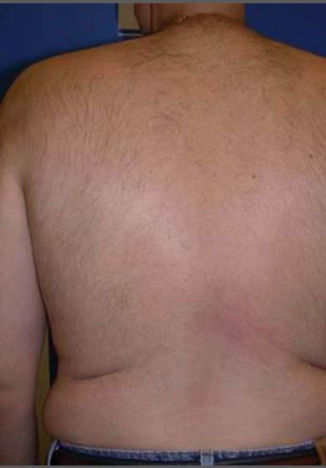 laser-hair-removal-4756-after