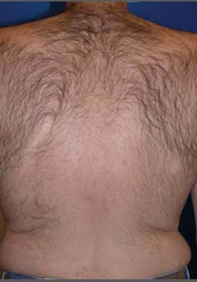 laser-hair-removal-4756-before