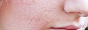 Acne Scarring Before Result Toronto & Mississauga
