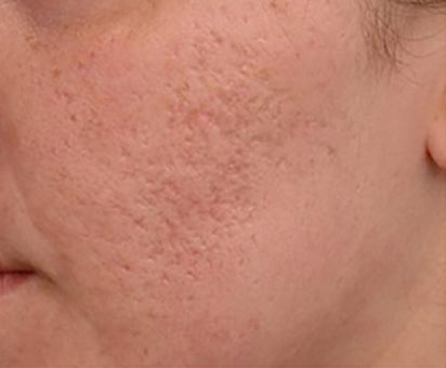 Acne Scarring Before Result Toronto & Mississauga