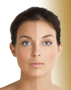 Hyperpigmentation Treatments Toronto & Mississauga