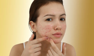 Acne Scar Treatments Toronto | Skinatomy Laser Clinic