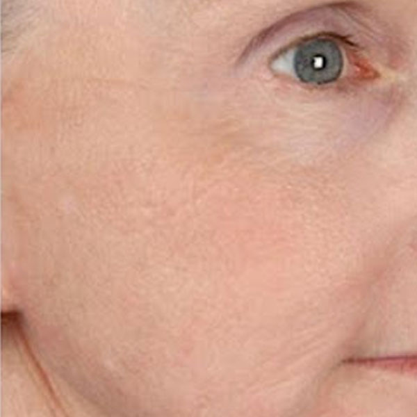 Anti-Aging Facial After Result Toronto & Mississauga