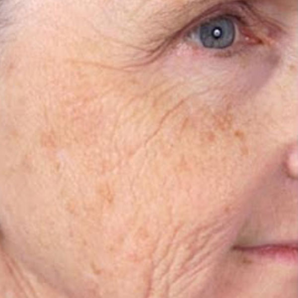 Anti-Aging Facial Before Result Toronto & Mississauga