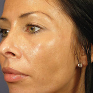 Chemical Peels After Toronto & Mississauga