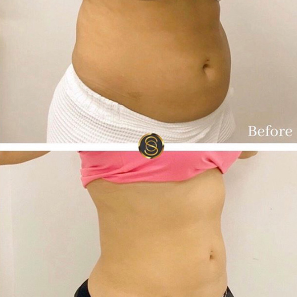 Lipolysis Fat Removal Before/After Result Toronto & Mississauga