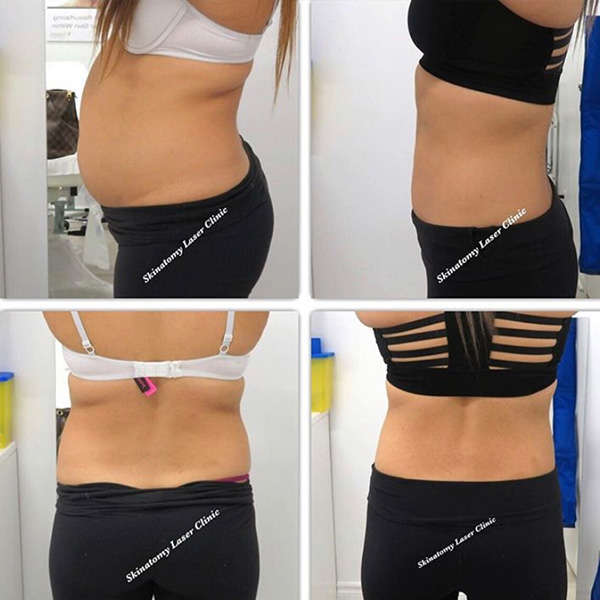 Lipolysis Fat Removal Before/After Result Toronto & Mississauga
