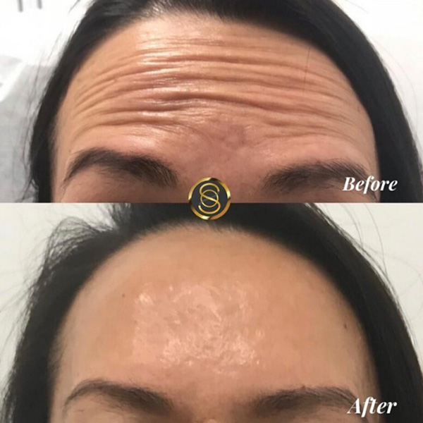 Botox Before/After Result Toronto & Mississauga