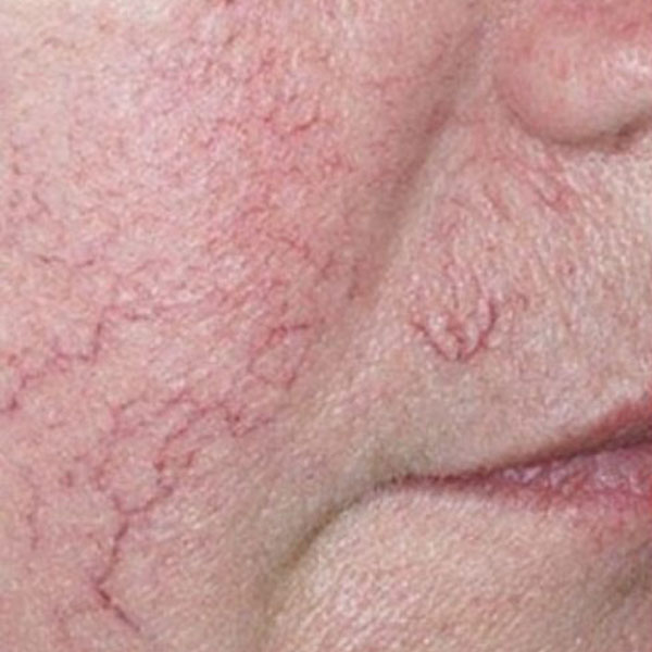Sensitive Skin / Rosacea Facials Before Result Toronto & Mississauga