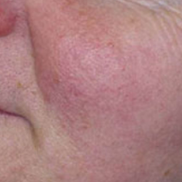 Sensitive Skin / Rosacea Facials After Result Toronto & Mississauga