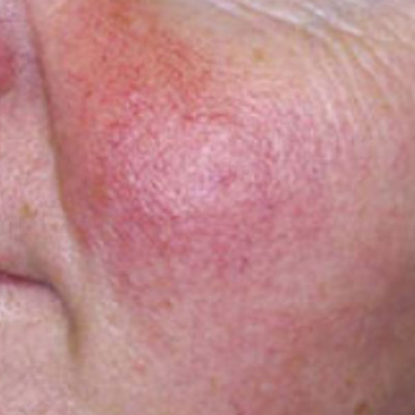 Sensitive Skin / Rosacea Facials Before Result Toronto & Mississauga