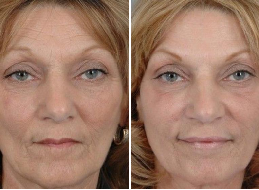 Botox Treatment Before/After Toronto & Mississauga