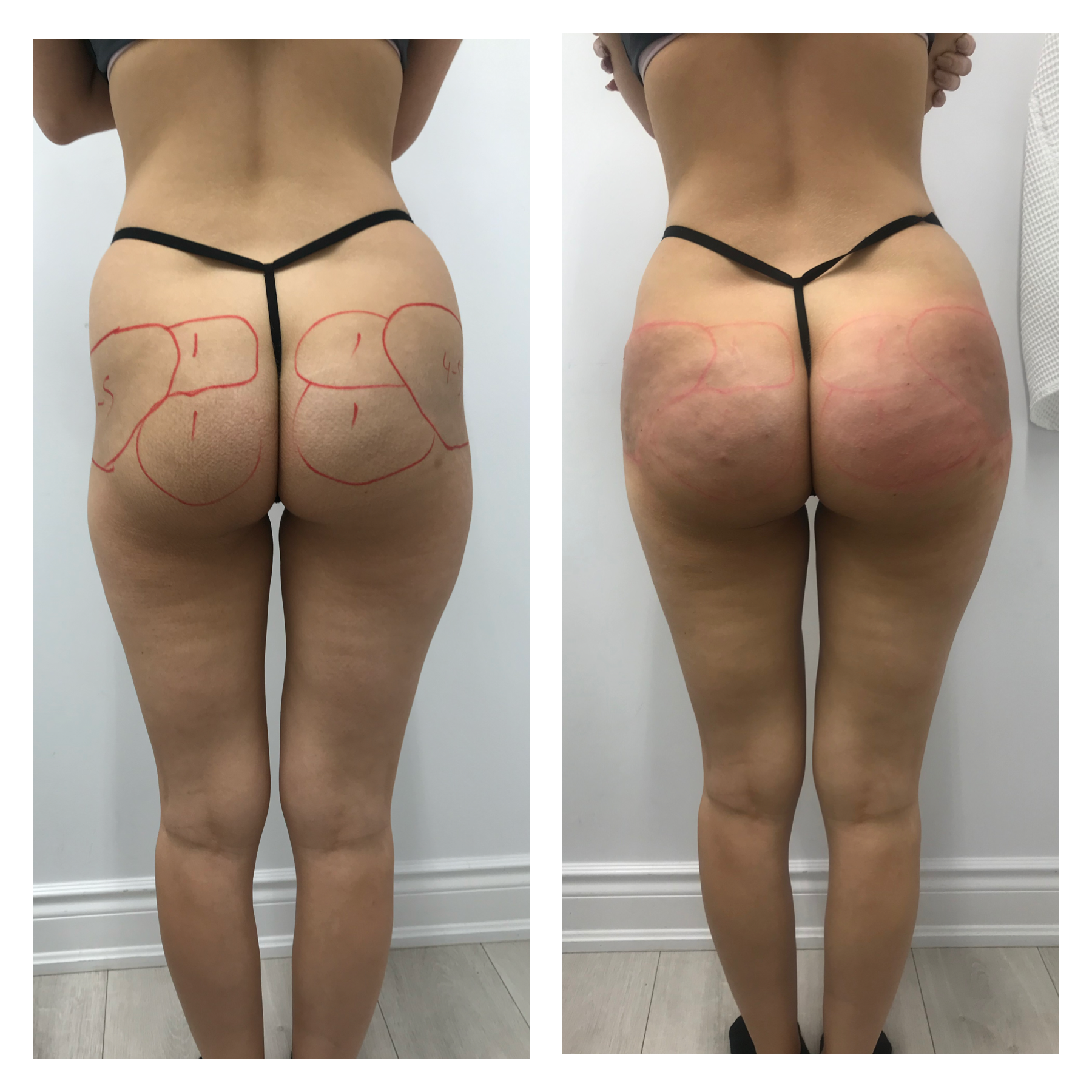Sculptra Radiesse Butt Lift Before After Result Toronto & Mississauga