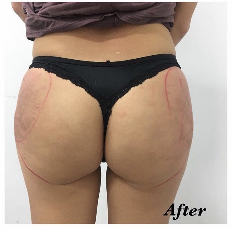 Sculptra Radiesse Butt Lift Before/After Result Toronto & Mississauga