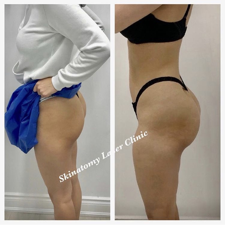 Sculptra Radiesse Butt Lift Before/After Result Toronto & Mississauga
