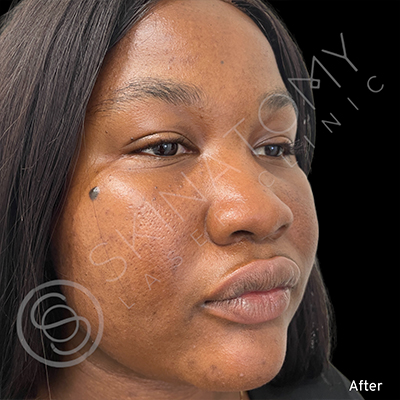 Acne Scarring After Result Toronto & Mississauga