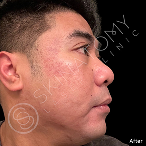 Acne Scarring After Result Toronto & Mississauga