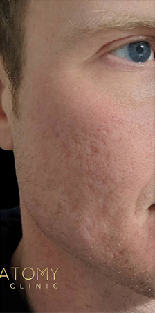 Acne Scar Treatments After Result Toronto & Mississauga