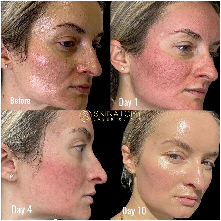 Acne Scarring Result Toronto & Mississauga