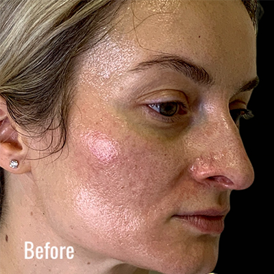 Acne Scars Before Result Toronto & Mississauga