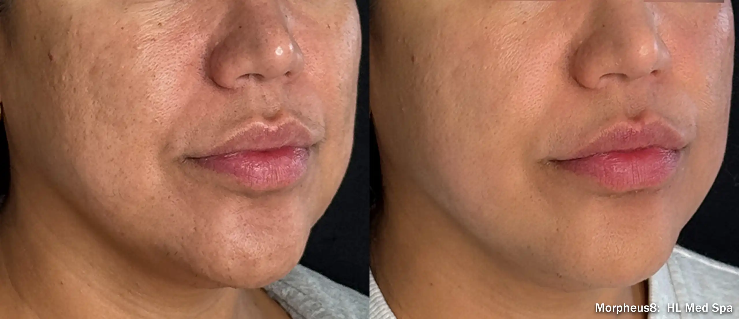 Side-by-side close-up of a woman's lower face, showing improved skin texture and slightly fuller lips after treatment.