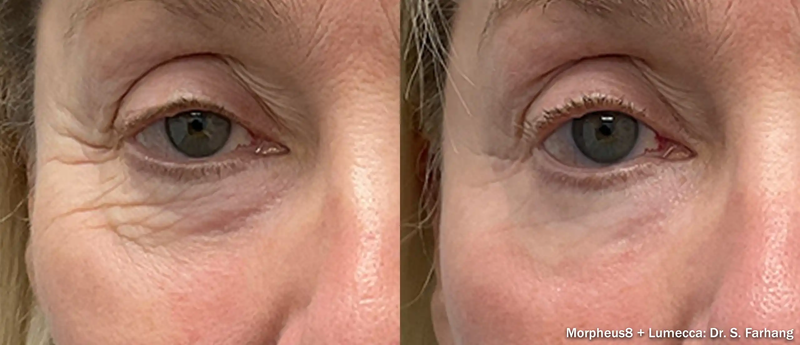 Side-by-side close-up of the eye area: left shows wrinkles and baggy under-eye skin, right shows smoother skin after cosmetic treatment (Morpheus8 + Lumecca). Watermark reads Morpheus8 + Lumecca: Dr. S. Farhang