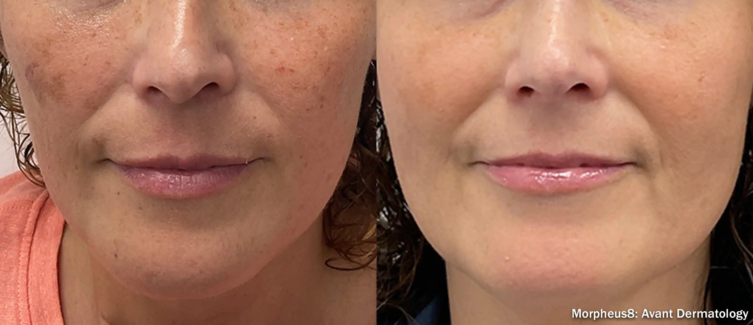 Before-and-after close-up of a woman's lower face showing improved skin texture and reduced redness after Morpheus8 treatment.