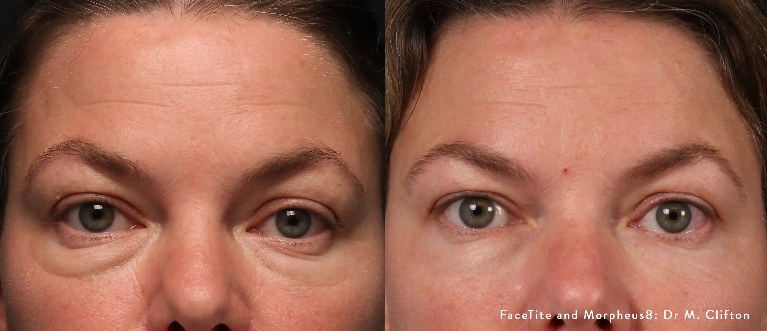 Side-by-side close-up of a woman’s eye area; left shows under-eye wrinkles and hooding, right shows smoother skin after facial rejuvenation (FaceTite/Morpheus8).