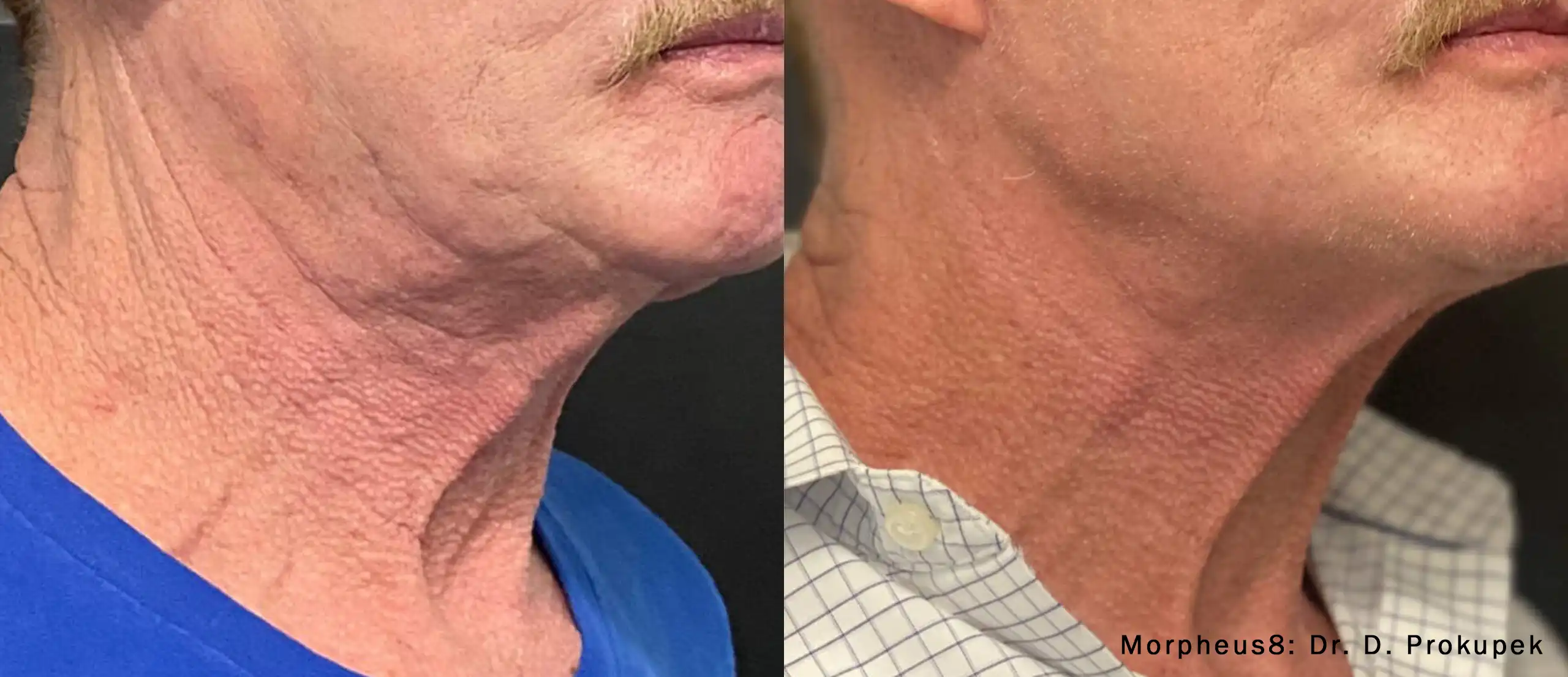 Before-and-after side profile of a man's neck showing tightened skin and reduced sagging after treatment.