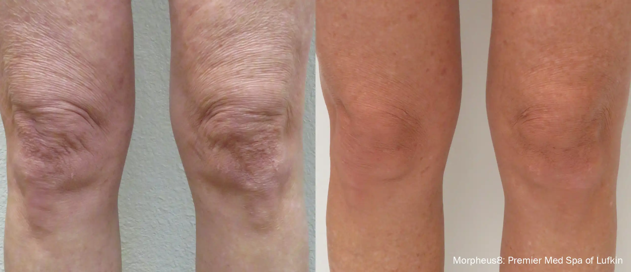 Side-by-side forearm comparison before and after Morpheus8 treatment, showing reduced wrinkles and smoother skin on the treated area.